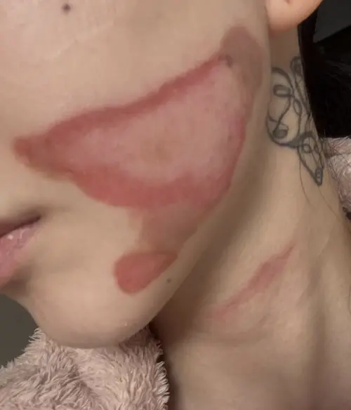 ▲權珉娥公開臉部嚴重燒傷照片。（圖／IG@new.kma）