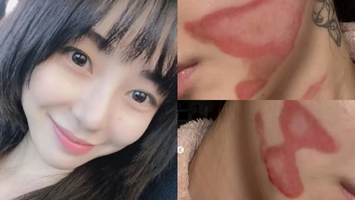 ▲AOA前成員權珉娥打音波醫美出事，她曬出自己臉頰二度燒燙傷的照片，表示「皮膚像被一層層剝開。」（圖／權珉娥IG ＠new.kma）