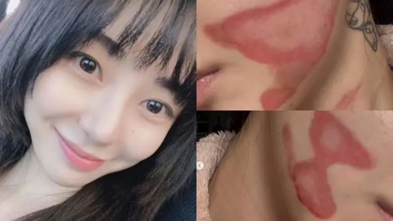 ▲AOA前成員權珉娥打音波醫美出事，她曬出自己臉頰二度燒燙傷的照片，表示「皮膚像被一層層剝開。」（圖／權珉娥IG ＠new.kma）