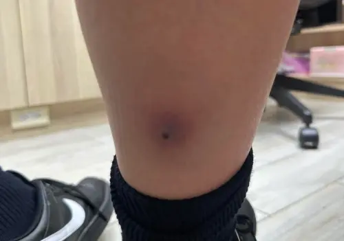 不是流感！12歲男童發燒無力　褲管一拉嚇壞醫：快轉急診、恐致死
