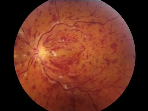 ▲ 打完三天麻將後，視力突然出現問題，左眼呈現視網膜靜脈擴張扭曲、彌漫性出血(類似火焰狀出血)、棉絮狀斑、視神經盤水腫、及可能的視神經盤邊界模糊。（圖／洪啟庭醫師提供）