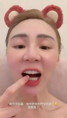 ▲短今吃飯時門牙斷裂，她不小心把斷掉的門牙吃下肚。（圖／短今s ᴀ ᴍ ᴍ ɪ ᴇ IG@sammie_923）