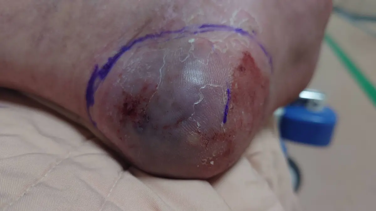 ▲個案遭龜殼花咬傷，醫師提醒，其毒液會影響凝血功能並造成組織壞死與傷口潰爛，導致局部肢體劇烈腫脹、瘀血，嚴重者可能面臨截肢等併發症。（圖／耕莘醫院提供）