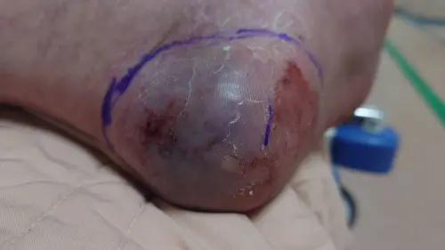 男在家遭龜殼花咬傷！冒瘀青血泡　醫示警：嚴重恐面臨截肢