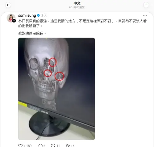 ▲宋燕旻說自己當初臉骨斷裂也在長庚接受治療的。（圖／宋燕旻Threads）