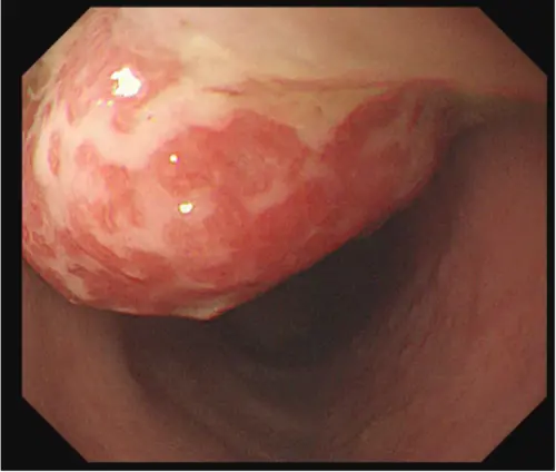 ▲3歲個案半年內反覆出現「間歇性血便」，檢查發現是息肉。（圖／台北慈濟醫院提供）
