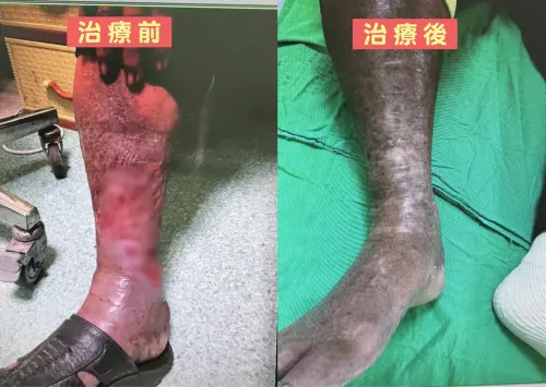 ▲醫師提醒，靜脈曲張不只影響外觀，若長期忽視恐會出現反覆潰瘍，面臨截肢風險。（圖／烏日林新醫院提供）