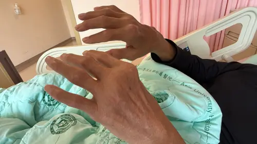 痛風不忌口　雞蛋大結石爆漿　醫：恐面臨截肢