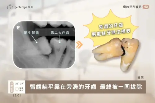 ▲智齒沒拔會怎樣？樂的牙醫分享真實案例，水平智齒（阻生智齒）因長歪推擠鄰牙，形成清潔死角導致第二大臼齒嚴重蛀牙，最終兩顆牙齒只能一同拔除。（圖／翻攝自樂的牙醫laperle.com.tw）