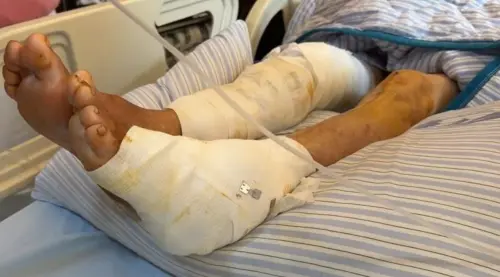 ▲陳嬤全身縫合約200針，尤其是四肢、臀部及背部的撕裂傷深可見骨，之後要接受高壓氧等療程。（圖／翻攝畫面）