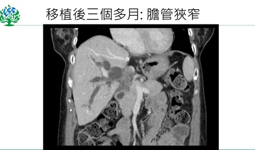▲個案移植後3個月出現併發感染與膽管狹窄，經置放膽管支架後，順利恢復。（圖／馬偕醫院提供）