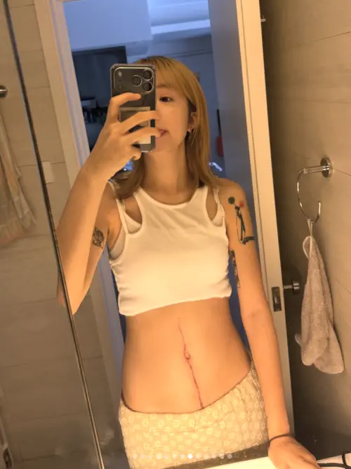 ▲YTR曉欣因抗癌而暫停更新頻道，但還是會在IG和粉絲分享近況，她秀出因開刀而留下的長疤。（圖／翻攝自曉欣IG@hhiuyyan）