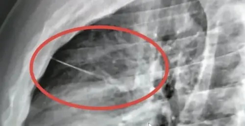 離奇胸痛無外傷！泰國男子體內竟插7公分縫衣針　貼心臟險喪命
