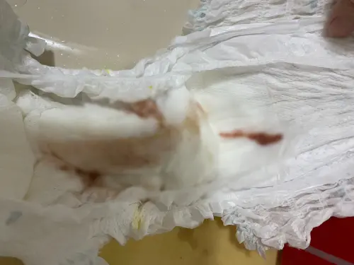 ▲10月大女嬰吃蒸蛋出現血便與發燒症狀送往急診。（圖／民眾提供）