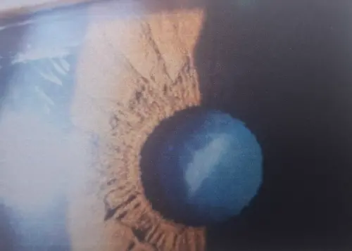 白內障外觀如台灣島　洪啟庭：連白內障也Team Taiwan