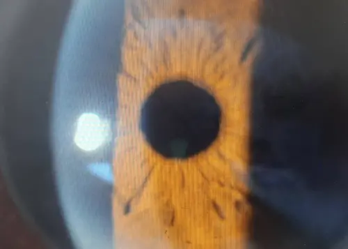 ▲ 病患在接受手術後，整個白內障已經被超音波乳糜化後吸收，最後植入人工水晶體，目前已觀察不到台灣島。（圖／洪啓庭醫師提供）