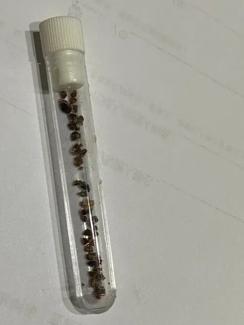 ▲雙側腎結石屬於高風險病況，雙側同時阻塞可能導致「急性腎衰竭」、「敗血症」等。（圖／中醫大新竹附醫提供）