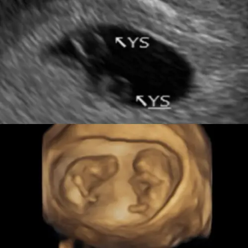 ▲鄭家純分享孕肚超音波照，說明上圖為發現同卵雙胞胎的那一天，下圖是10週時所拍攝。（圖／鄭家純臉書）