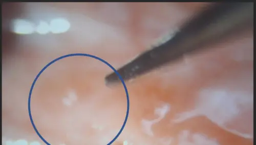 電競國手勤於電玩與電競訓練　生出近千顆眼結石且復發中