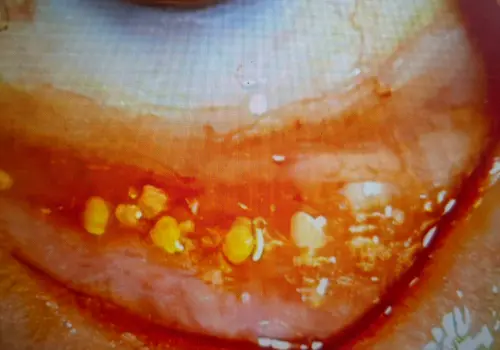 ▲洪啟庭提醒，清理完眼結石後3至6個月內，將有30到50%的患者會復發，由於患者用眼習慣未改善，原本的眼結石經部分清除後，3個月後又冒出更大的眼結石。（圖／洪啟庭提供）