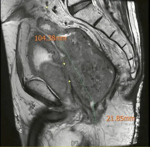 ▲黃晟瑋醫師說明，從核磁共振影像顯示，王男腫瘤大小。（圖／黃晟瑋提供）