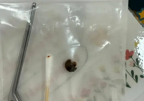 ▲巨型耳垢終於在這次診療中清理乾淨，阿伯治療完成當下眼神發亮，嘴角微笑完全止不住，甚至拿出手機拍下困擾他10年之久的耳垢，還將其放進夾鏈袋帶回家。（圖／翻攝郭子龍醫師臉書）