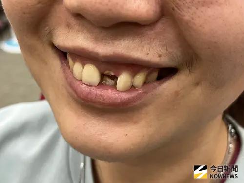缺14顆牙失智風險高10倍！北榮研究：咬合問題早已影響大腦