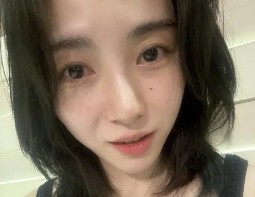 珉娥音波二度燒燙傷慘毀容！工作損失1億韓元還遭院長反告恐嚇