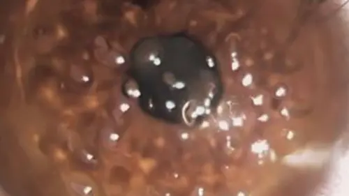 ▲病患右眼整個角膜範圍幾乎都出現水泡，此讓其感覺刺痛與異物感。（圖／醫師洪啟庭提供提供）