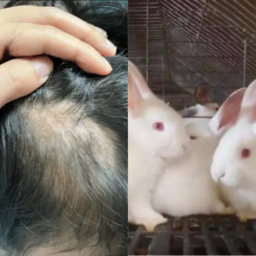 5歲童摸兔子頭皮長膿包！毛囊壞死禿一塊　醫師警告這年齡最危險
