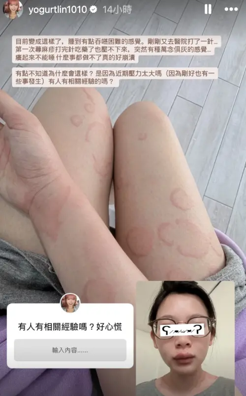 ▲優格姐姐蕁麻疹發作，求助網友。（圖／翻攝自IG@yogurtlin1010）