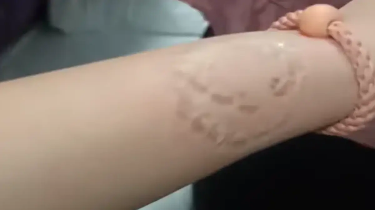 ▲中國江蘇1名女子，近日在搭火車時與人發生糾紛，遭對方咬傷，幾天後傷口出現詭異疱疹，令她擔心對方是否患有疾病並傳染給她。（圖／翻攝自揚子晚報）