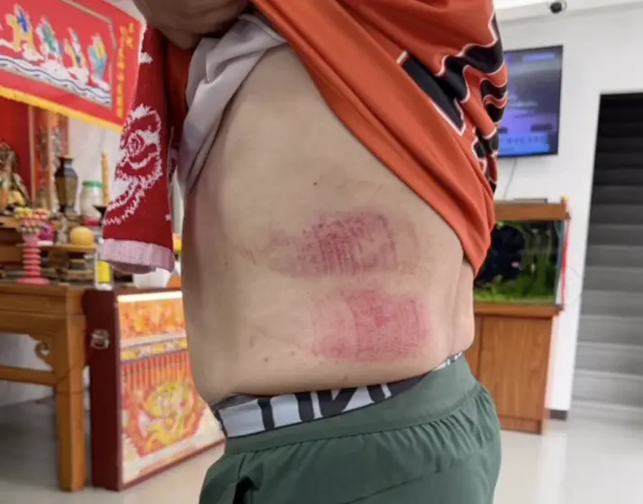    ▲郭鴻儀拼命爬出脫困，全身多處擦傷與紅腫，直呼命差點被收走。（圖／臉書郭鴻儀-議員日常）  