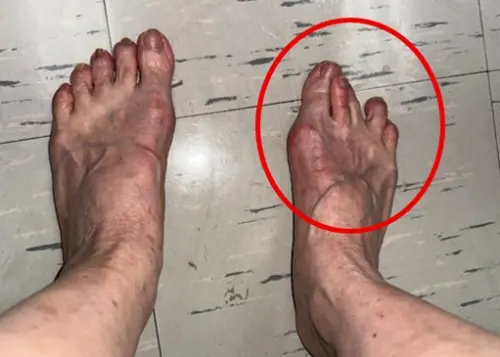 出國玩狂走2萬步！「急性拇趾外翻」門診人變多　腳底長繭小心
