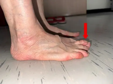 ▲拇趾外翻是指「大腳趾往第二腳趾偏移」。當外翻角度過大，大腳趾根部的骨頭會向外凸出。（圖／北市聯醫提供）