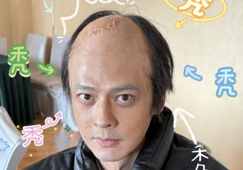 49歲郭品超變大禿頭！裸上身背後全是刀疤　粉絲崩潰：這太嚇人了
