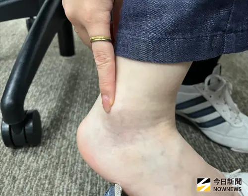 水腫or真的胖？中醫教1招分辨：先別急著喝紅豆水