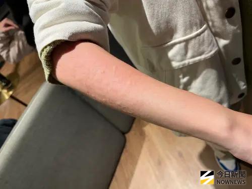 ▲醫師提醒，若不小心將硝基呋喃殘留的食物吃下肚，可能會引起過敏。（圖／記者張乃文攝）