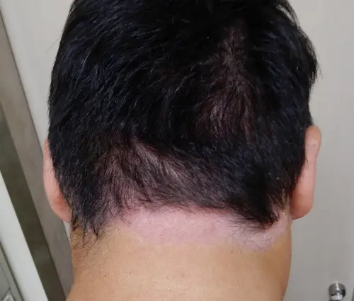 包緊緊避社交　男乾癬精準治療恢復9成