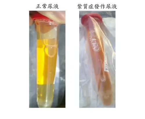 ▲紫質症患者的尿液，發作時在光照下逐漸呈現紅棕色；左圖為正常尿液。（圖／長庚醫院提供）