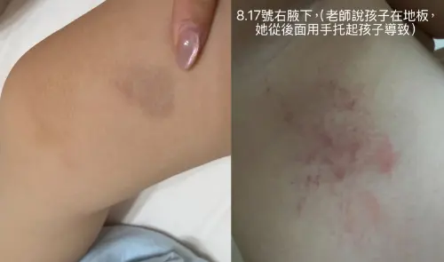 ▲女童的腋下、大腿內側都有明顯瘀傷。（圖／林祈烽提供，2026.08.20）