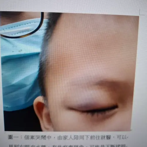中元普渡海苔揉進眼裡　洪啟庭籲：絕對禁止再搓揉眼
