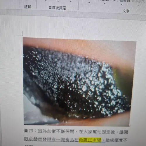 ▲撐開幼童眼皮赫然發現有一塊食品在角膜正中間，可能因為是海苔，其許多特讓海苔片緊緊吸附角膜。（圖／達特楊眼科聯盟執行長洪啟庭提供）