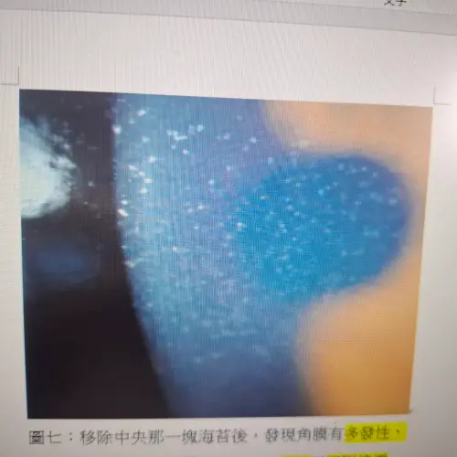 ▲移除中央海苔後，發現角膜有多發性、瀰漫性的點狀上皮病變，會使幼童疼痛與不斷流淚。（圖／達特楊眼科聯盟執行長洪啟庭提供）