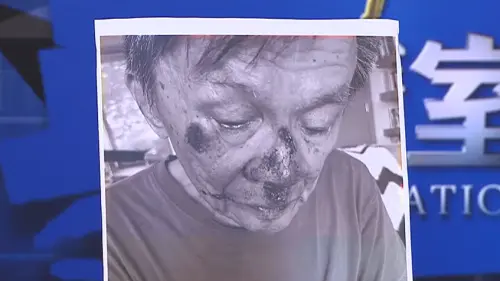 87歲沈富雄重摔「滿臉全血」！驚悚傷照曝光：腎臟移植過才這樣跌