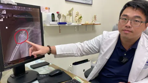 ▲ 員榮醫院骨科醫師姜良諭指出，病人接受反式人工肩關節置換後，右手已可抬高、自行洗頭。（圖／員榮醫院提供）