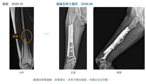 ▲患者接受「免截骨／少截骨」冷凍治療的手術前後X光照片對比，術後5年骨頭生長良好且結構更為強壯。（圖／北榮提供）
