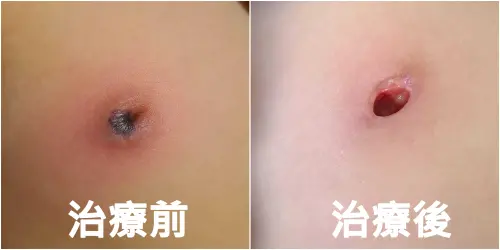 國小童高燒不退！乳頭紅腫　醫檢查驚「幾乎被吃光」
