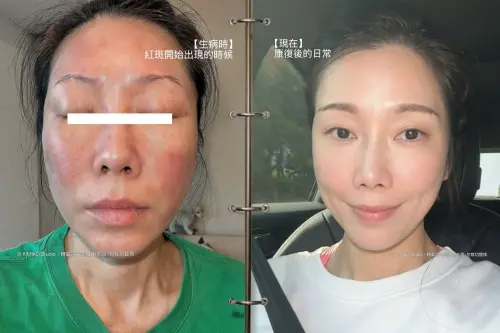 KIMIKO驚爆送急診！全身突冒紅斑、臉浮腫病因曝光：鬼門關走一遭