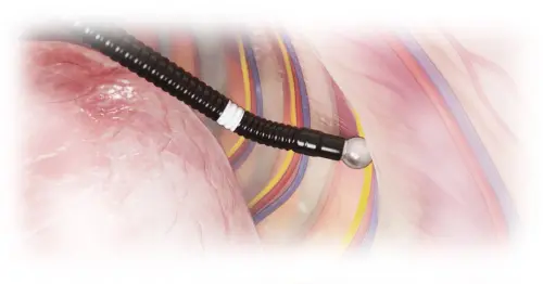 ▲長庚醫院導入「冷凍消融神經阻斷止痛技術（Cryo Nerve Block）」，透過肋間神經冷凍至極低溫，使其暫時「冬眠」。（圖／長庚醫院提供）